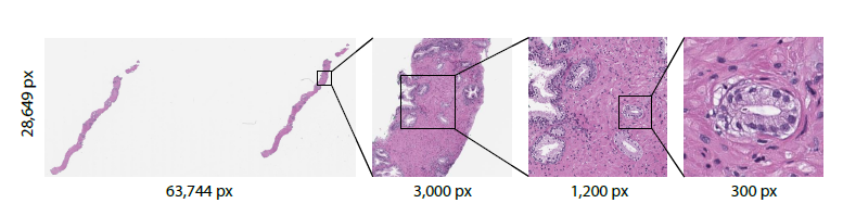 AI Helps Detect Prostate Cancer