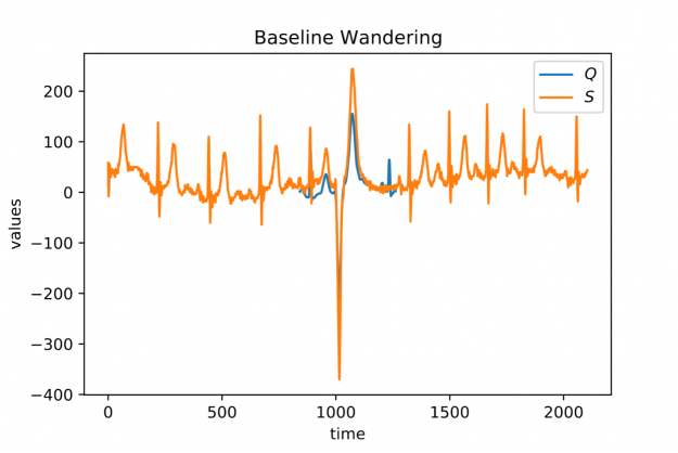 A plot consisting of two graphs depicting a short heartbeat sequence aligned in a much longer stream of continuously measured heartbeats. The locally averaged stream values are drifting over time.