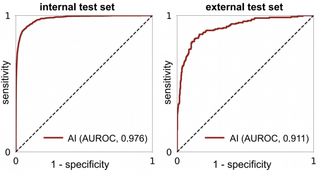 Improving Breast Cancer Detection in Ultrasound Imaging Using AI