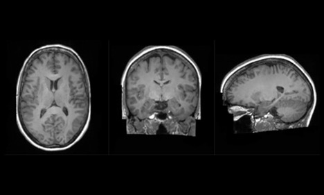 3D image of a brain from 3 angles