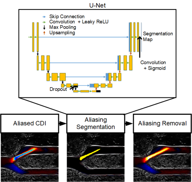 A pretrained U-Net convolutional neural network segments aliasing artifacts in Color Doppler images. The segmented artifacts are then removed by an adaptive phase unwrapping algorithm.