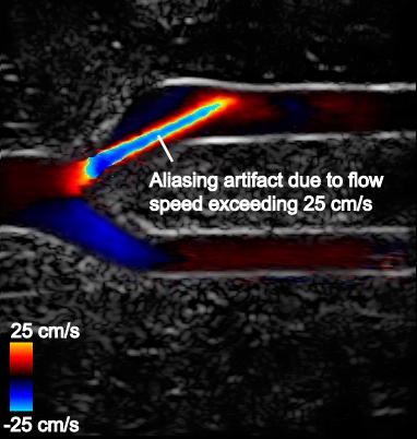 Blood flow speed in the upper branch exceeds the maximum measurable speed (25 cm/s) and wraps around from red to blue, incorrectly indicating that flow is going in the opposite direction.