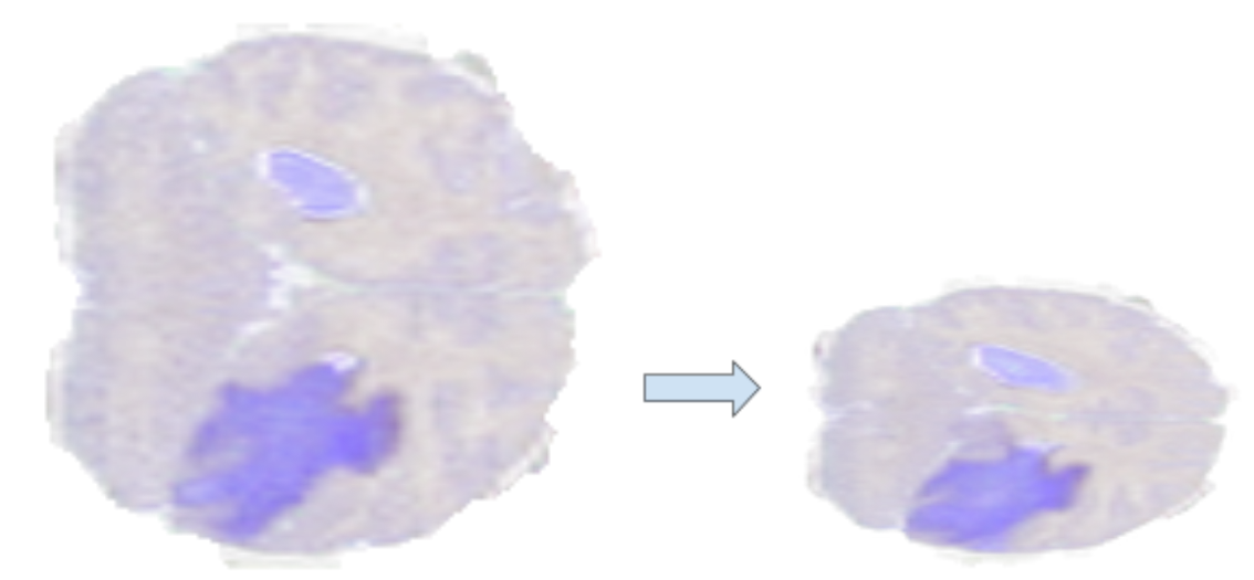 The left image shows a cut of the brain scan with a region highlighted in a different color that represents an abnormality; a tumor in this case. The right image is a recalled cut, where the height dimension is more aggressively scaled than the width.