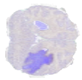 A cut of the brain scan with a region highlighted in a different color that represents an abnormality; a tumor in this case.