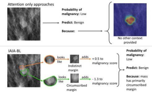 New AI Breast Cancer Model Is The First To Show Diagnostic Process ...