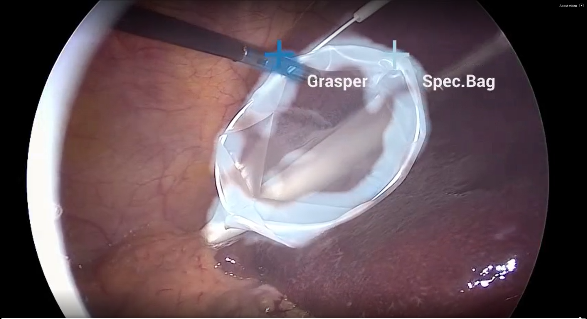 Frame by frame identification and tracking in endoscopy