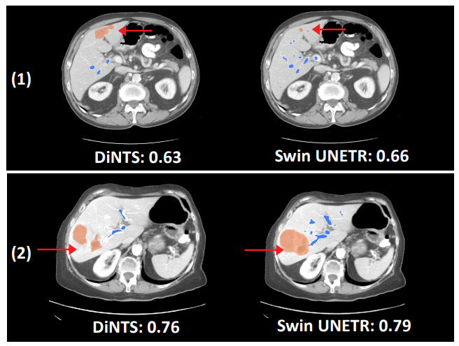 Dice score of Swin UNETR compared to DiNTS of organ segmentation.
