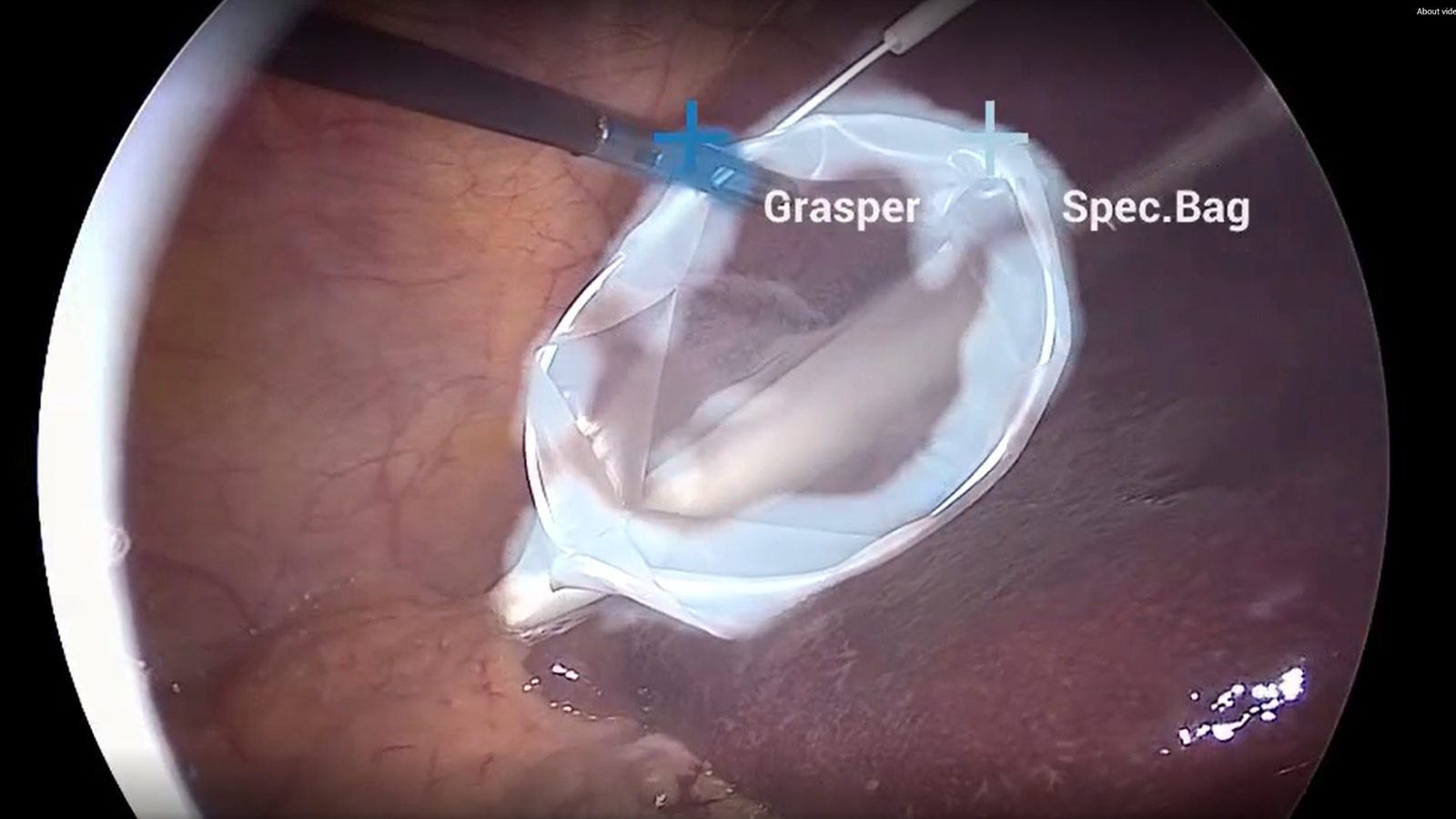 Frame by frame identification and tracking in endoscopy