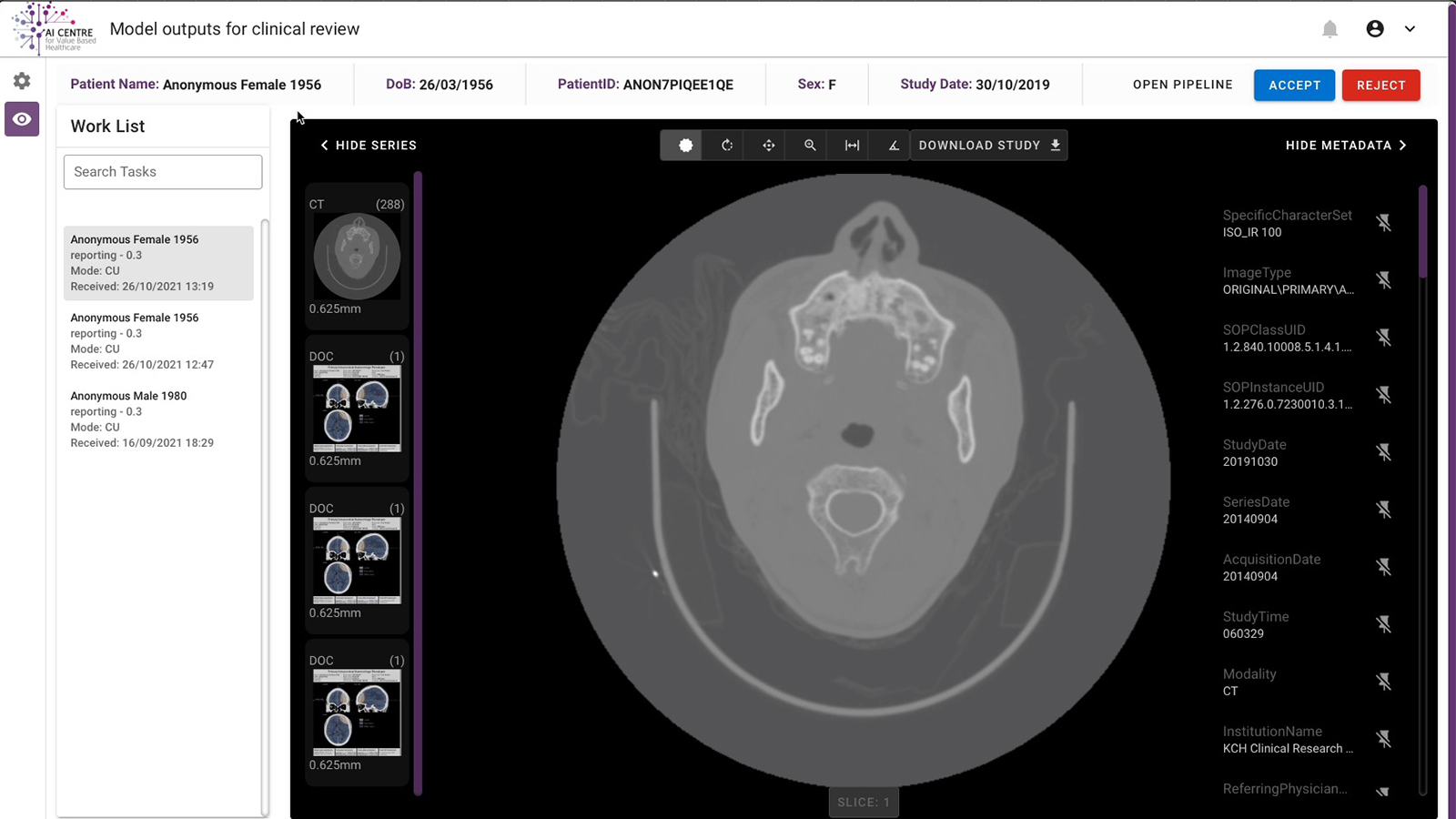 Screenshot of a clinical review user interface of a MAP for segmenting a stroke lesion in a brain scan. Three patient records appear on the left with subsequent scans, segmentations, and metadata in the viewer.