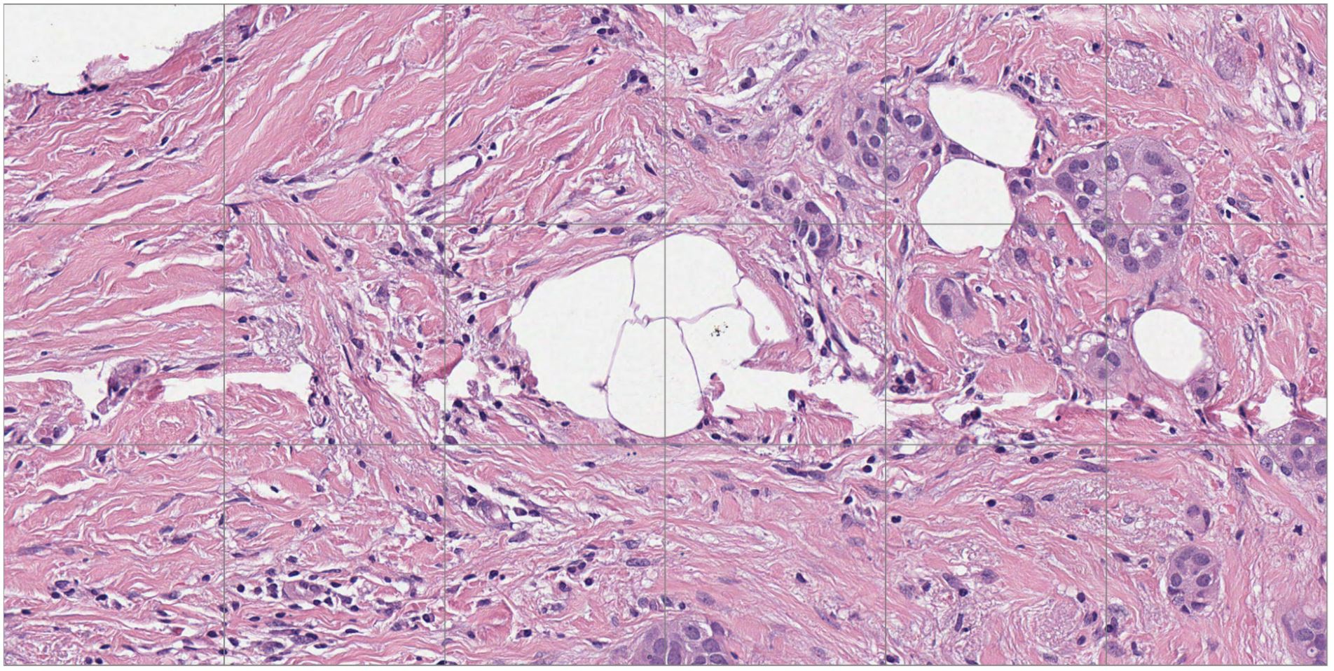 Zoomed view of a small section of the H&E-stained digital pathology slide showing in Figure 1.