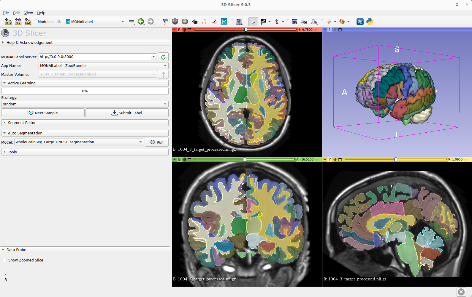 3D Slicer user interface showing segmentation of anatomical structures in a brain from multiple angles.