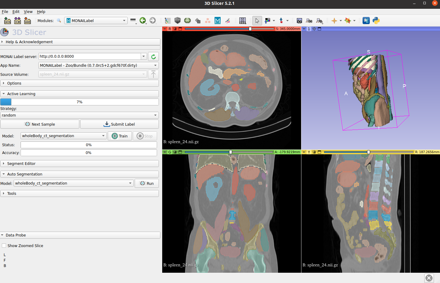 3D Slicer user interface showing segmentations of a torso from multiple angles.
