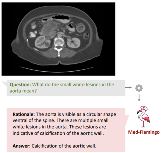 Rationale and answer generated by Med-Flamingo in response to image and question about lesions in aorta. 
