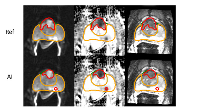 AI Research Delivers Rapid, Accurate Prostate Cancer Predictions