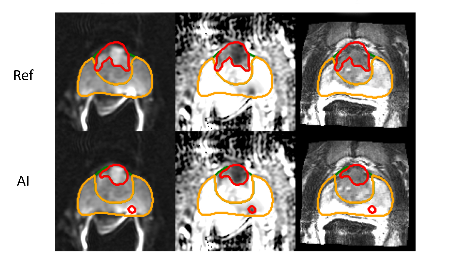 An MRI of cancer tumors.